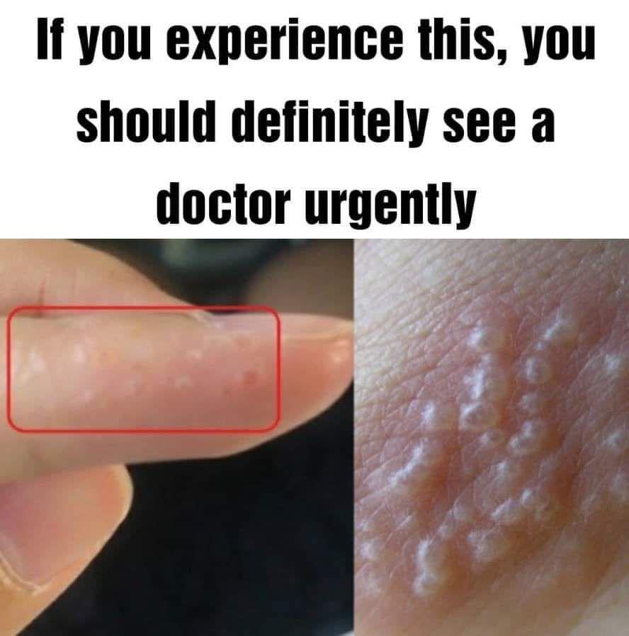 If You Notice Painful Red Bumps, You Might Have Dyshidrotic Eczema